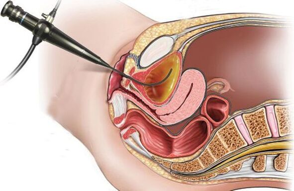 Cystoscopie pour la cystite